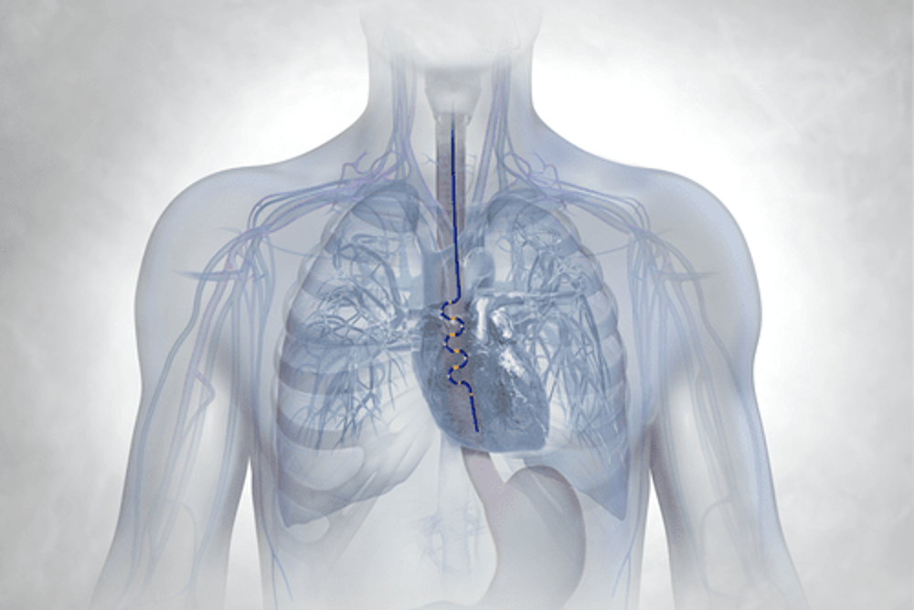 x-ray-image-of-cath-monitor-inside-esophagus